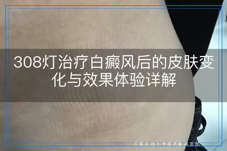 308灯治疗白癜风后的皮肤变化与效果体验详解