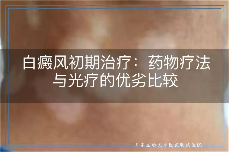 白癜风初期治疗：药物疗法与光疗的优劣比较