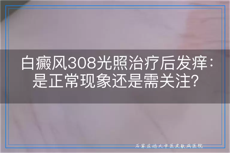 白癜风308光照治疗后发痒：是正常现象还是需关注？