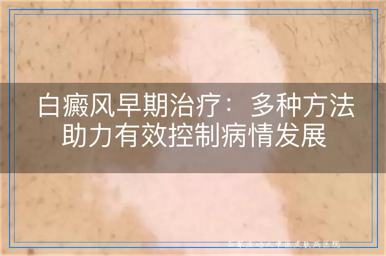 白癜风早期治疗：多种方法助力有效控制病情发展