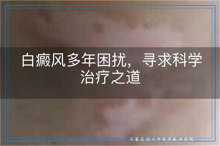 白癜风多年困扰，寻求科学治疗之道