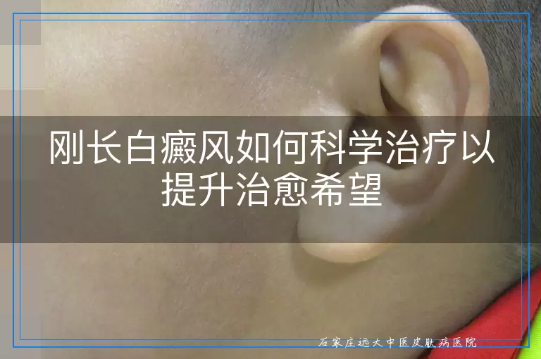刚长白癜风如何科学治疗以提升治愈希望