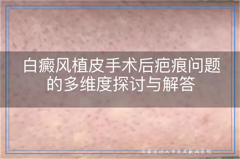 白癜风植皮手术后疤痕问题的多维度探讨与解答