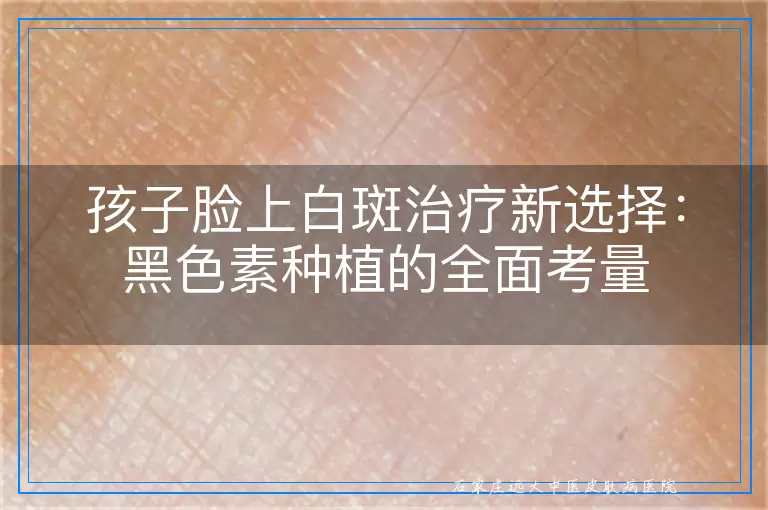 孩子脸上白斑治疗新选择：黑色素种植的全面考量