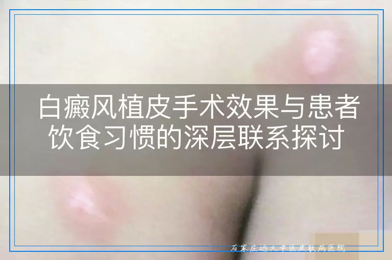 白癜风植皮手术效果与患者饮食习惯的深层联系探讨