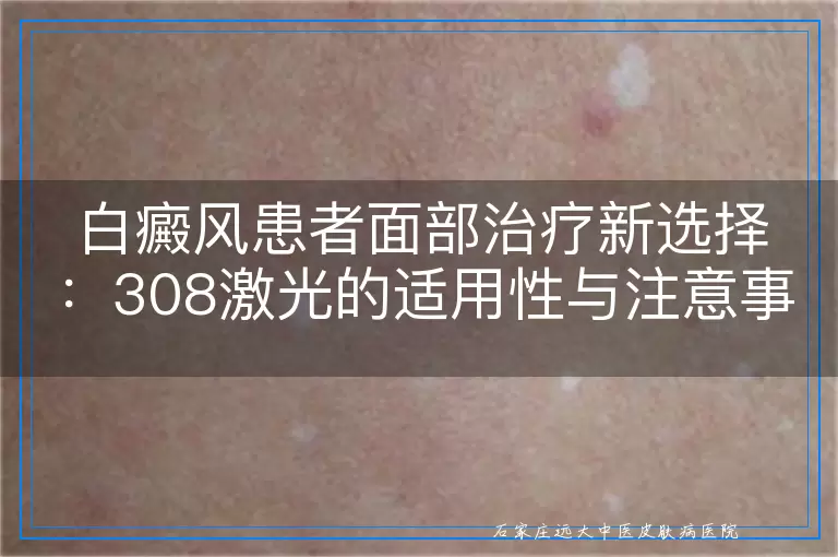 白癜风患者面部治疗新选择：308激光的适用性与注意事项