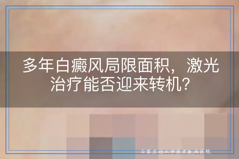 多年白癜风局限面积，激光治疗能否迎来转机？
