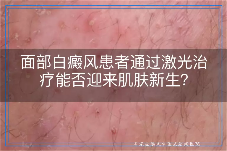 面部白癜风患者通过激光治疗能否迎来肌肤新生？
