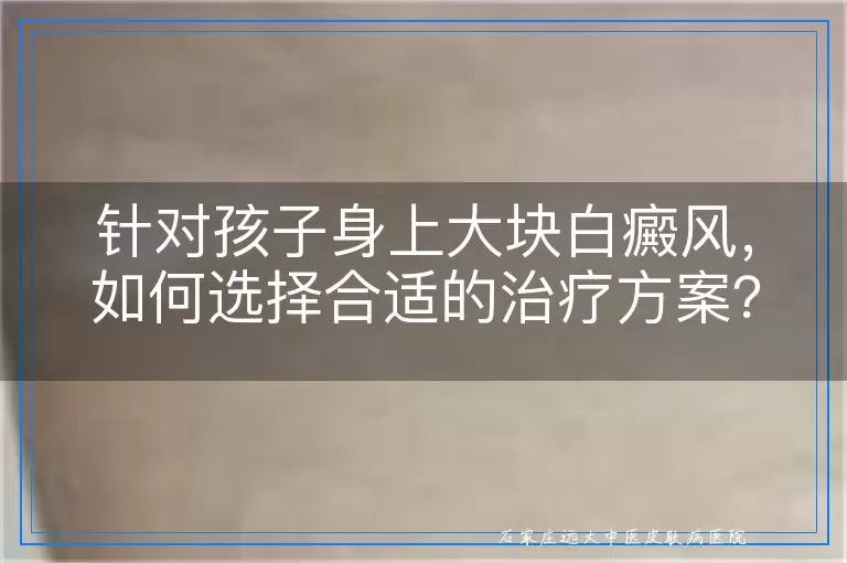 针对孩子身上大块白癜风，如何选择合适的治疗方案？