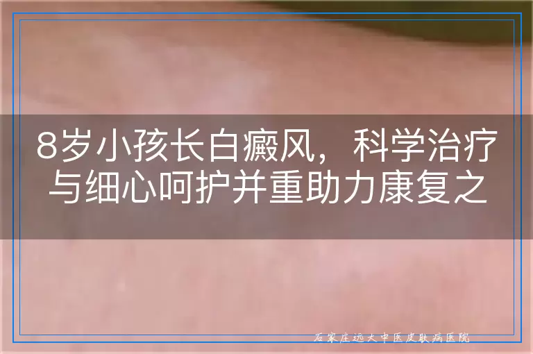 8岁小孩长白癜风，科学治疗与细心呵护并重助力康复之路