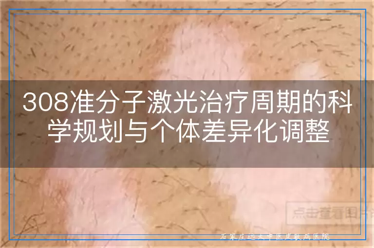 308准分子激光治疗周期的科学规划与个体差异化调整