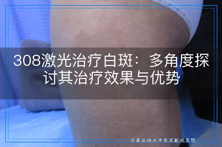 308激光治疗白斑：多角度探讨其治疗效果与优势