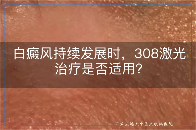 白癜风持续发展时，308激光治疗是否适用？