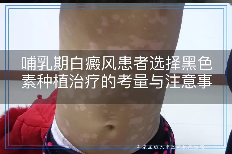 哺乳期白癜风患者选择黑色素种植治疗的考量与注意事项