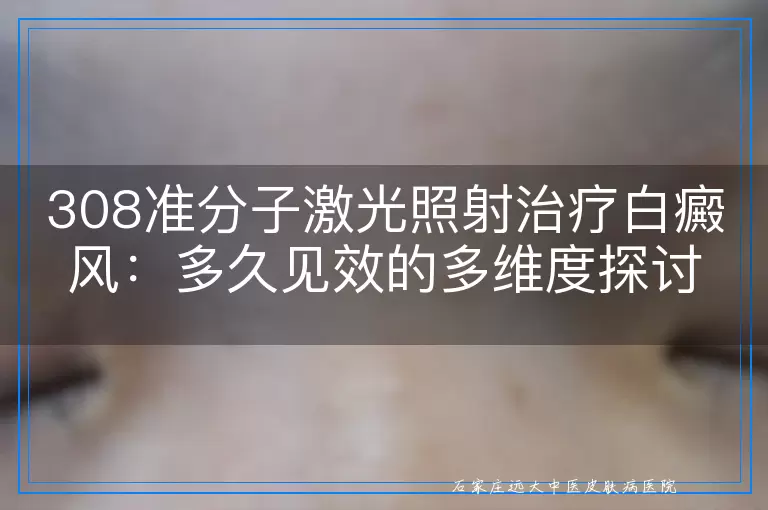308准分子激光照射治疗白癜风：多久见效的多维度探讨