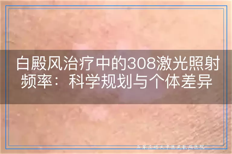 白殿风治疗中的308激光照射频率：科学规划与个体差异的考量