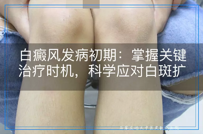 白癜风发病初期：掌握关键治疗时机，科学应对白斑扩散