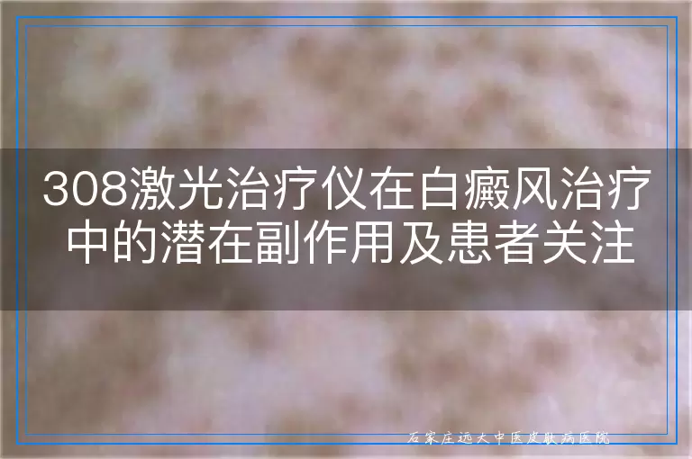 308激光治疗仪在白癜风治疗中的潜在副作用及患者关注点