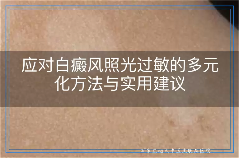 应对白癜风照光过敏的多元化方法与实用建议