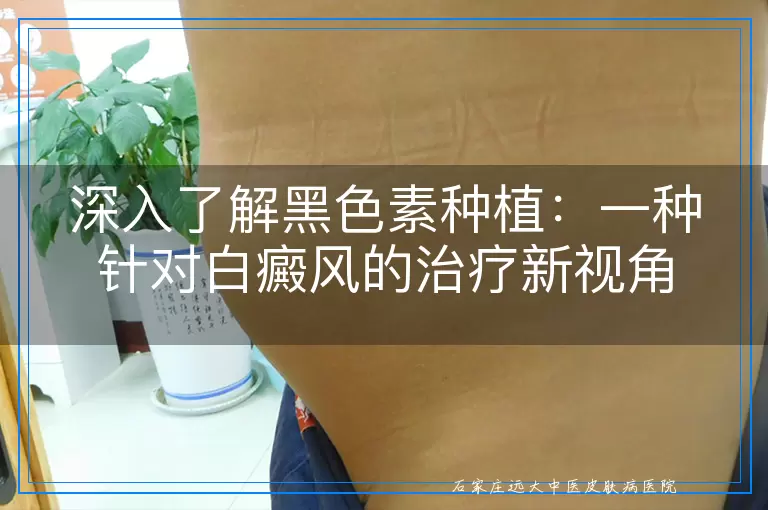深入了解黑色素种植：一种针对白癜风的治疗新视角