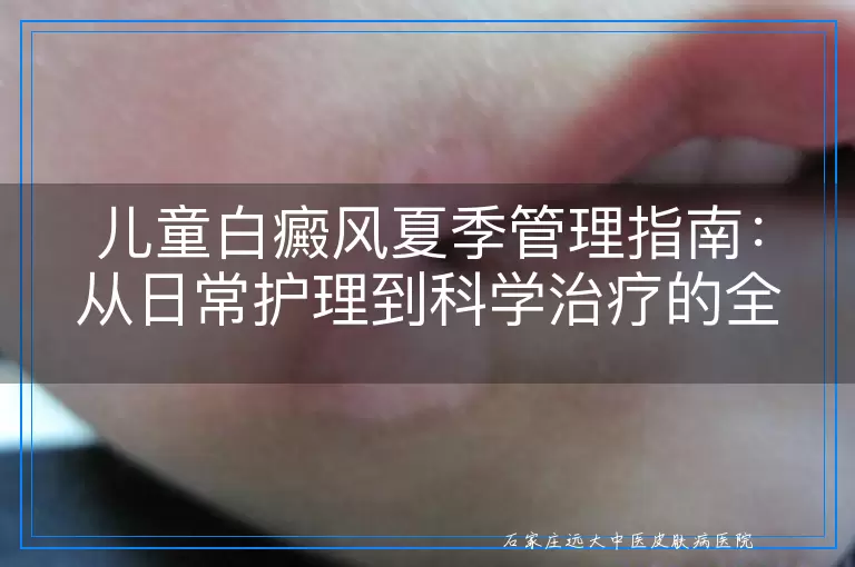 儿童白癜风夏季管理指南：从日常护理到科学治疗的全方位建议