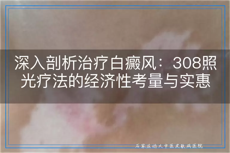 深入剖析治疗白癜风：308照光疗法的经济性考量与实惠之选