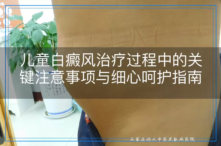 儿童白癜风治疗过程中的关键注意事项与细心呵护指南
