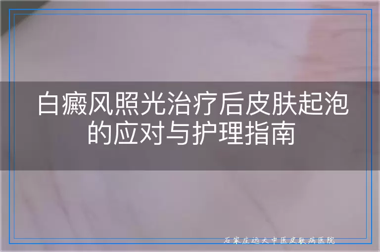 白癜风照光治疗后皮肤起泡的应对与护理指南