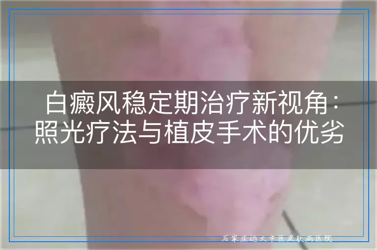 白癜风稳定期治疗新视角：照光疗法与植皮手术的优劣对比