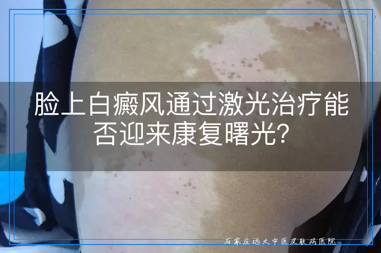 脸上白癜风通过激光治疗能否迎来康复曙光？