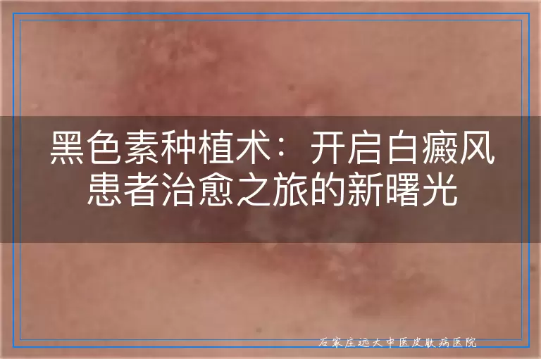 黑色素种植术：开启白癜风患者治愈之旅的新曙光