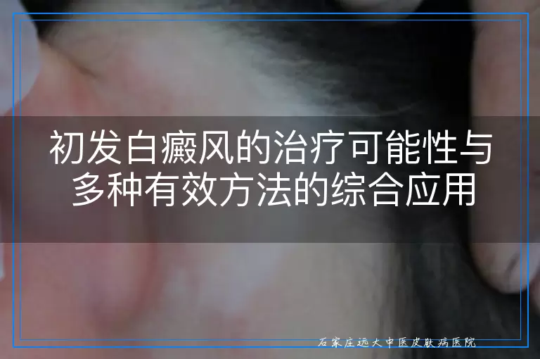 初发白癜风的治疗可能性与多种有效方法的综合应用
