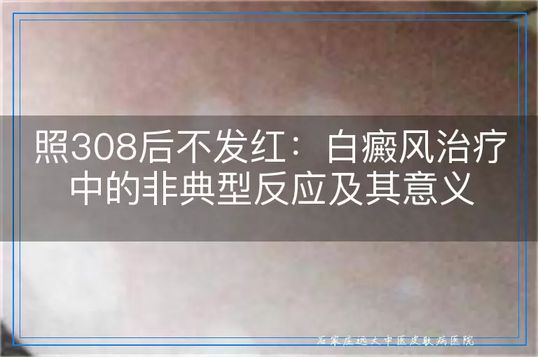 照308后不发红：白癜风治疗中的非典型反应及其意义