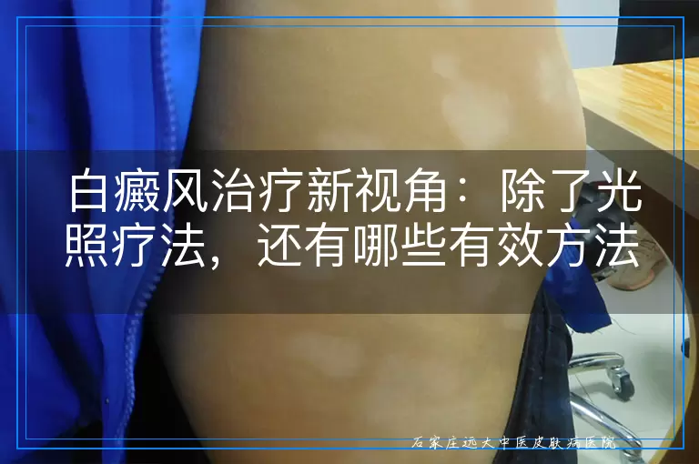 白癜风治疗新视角：除了光照疗法，还有哪些有效方法值得尝试？