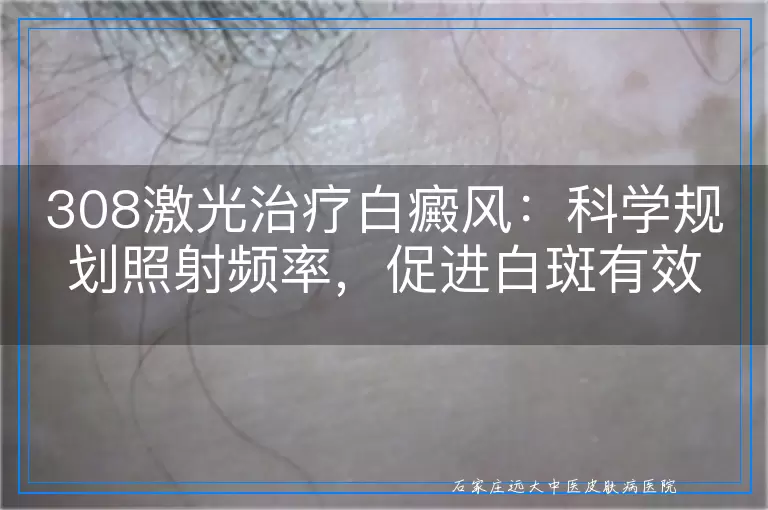 308激光治疗白癜风：科学规划照射频率，促进白斑有效恢复