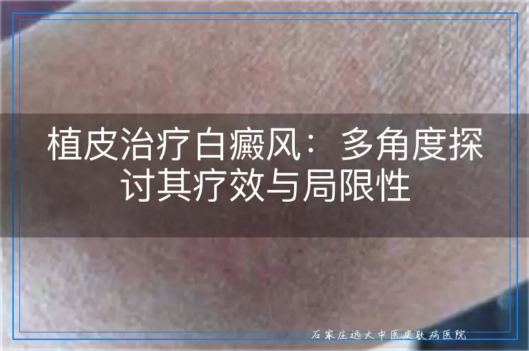 植皮治疗白癜风：多角度探讨其疗效与局限性
