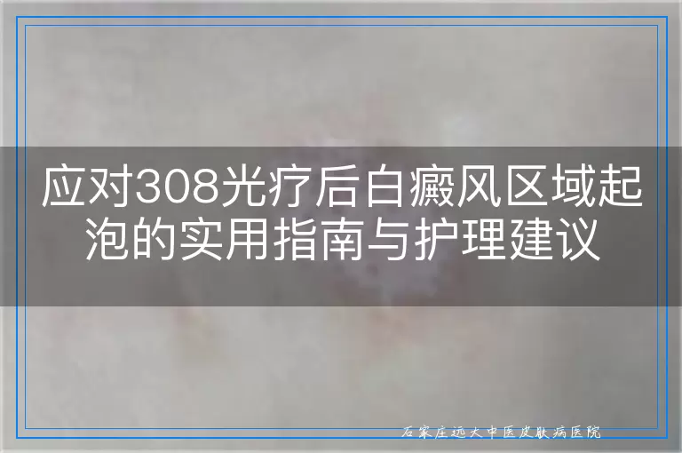 应对308光疗后白癜风区域起泡的实用指南与护理建议