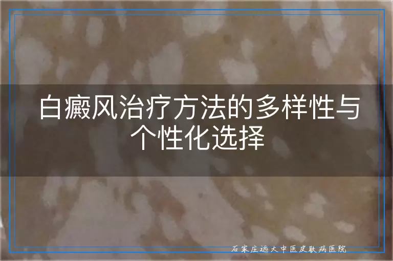 白癜风治疗方法的多样性与个性化选择