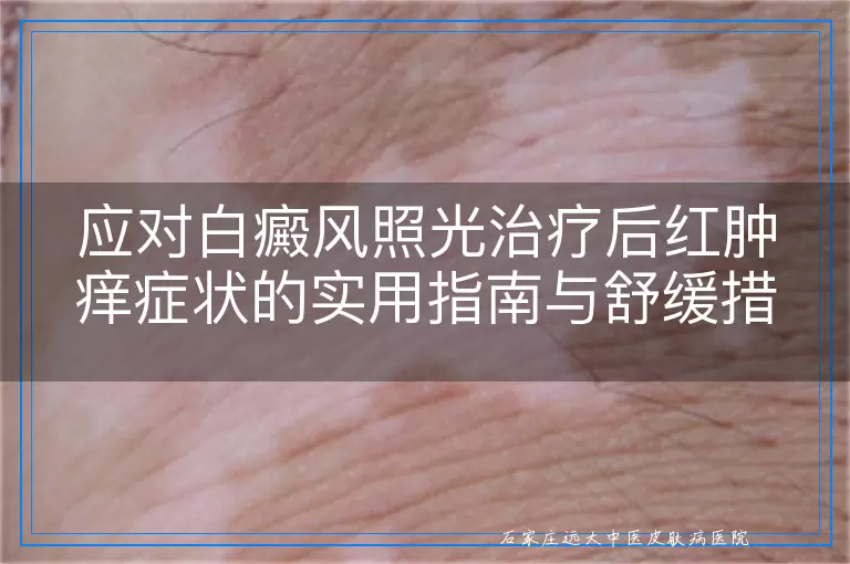 应对白癜风照光治疗后红肿痒症状的实用指南与舒缓措施