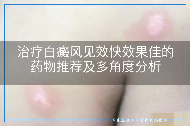 治疗白癜风见效快效果佳的药物推荐及多角度分析