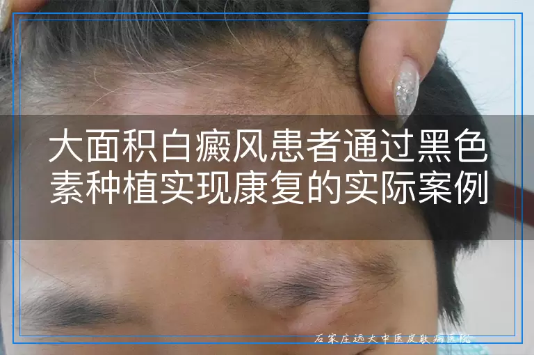 大面积白癜风患者通过黑色素种植实现康复的实际案例与效果观察