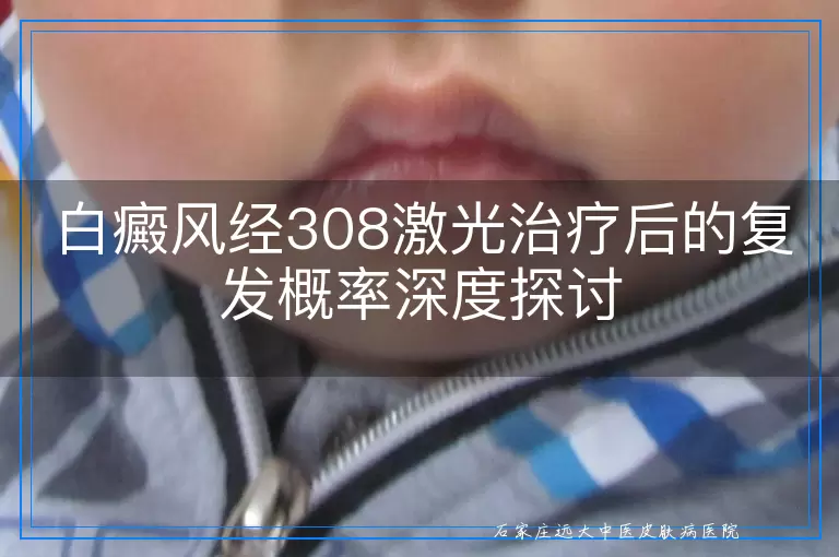 白癜风经308激光治疗后的复发概率深度探讨