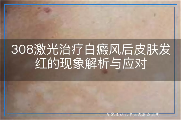 308激光治疗白癜风后皮肤发红的现象解析与应对