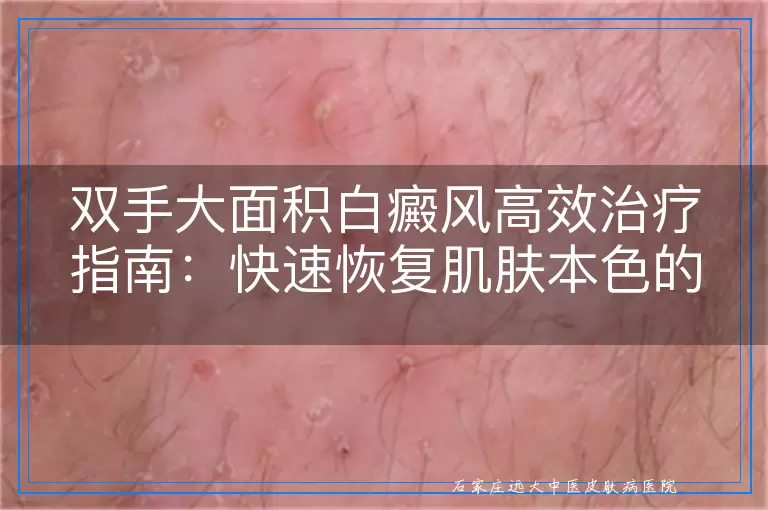 双手大面积白癜风高效治疗指南：快速恢复肌肤本色的方法与建议