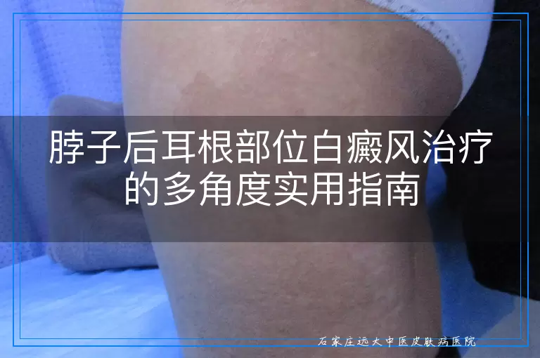 脖子后耳根部位白癜风治疗的多角度实用指南