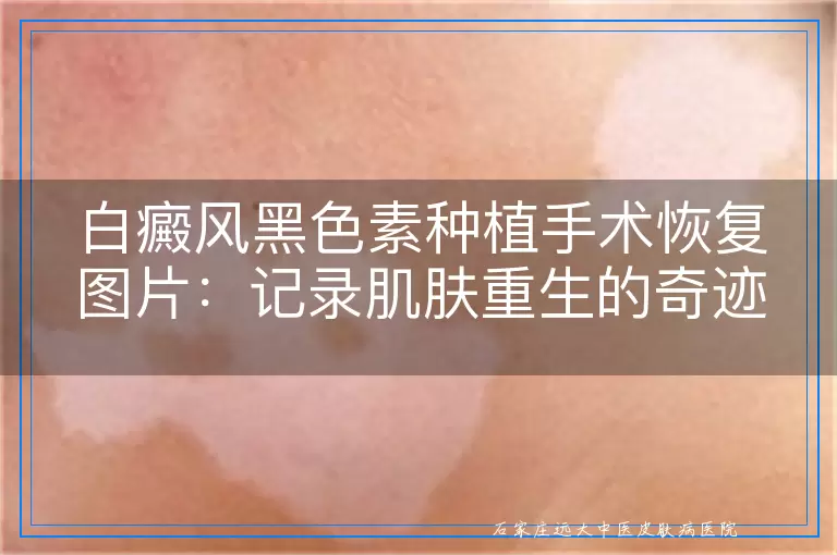 白癜风黑色素种植手术恢复图片：记录肌肤重生的奇迹瞬间