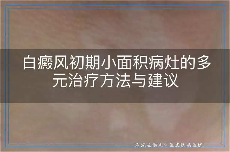 白癜风初期小面积病灶的多元治疗方法与建议