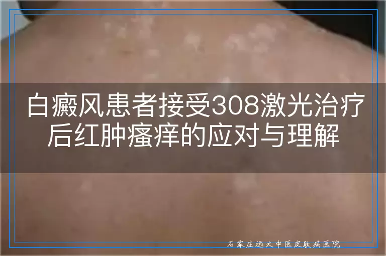 白癜风患者接受308激光治疗后红肿瘙痒的应对与理解