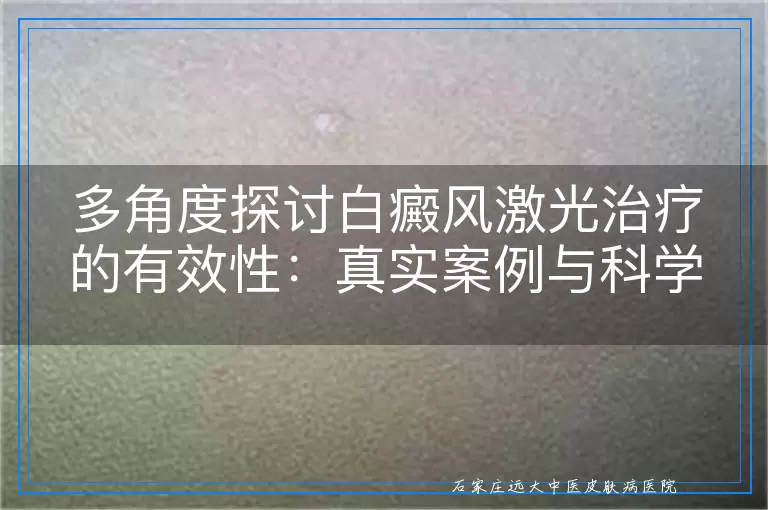 多角度探讨白癜风激光治疗的有效性：真实案例与科学解析