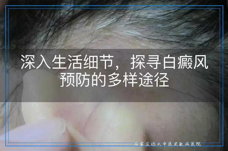 深入生活细节，探寻白癜风预防的多样途径